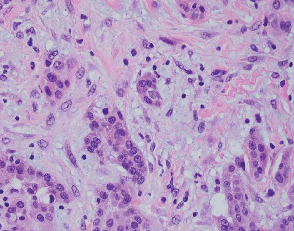 Figure 21.15, Epithelioid mesothelioma with extracellular hyaluronic acid (H&E, 400×).