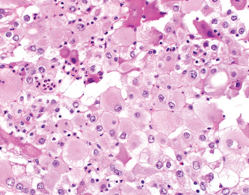 Figure 21.16, Epithelioid malignant mesothelioma with deciduoid features, showing abundant granular eosinophilic cytoplasm (H&E, 400×).