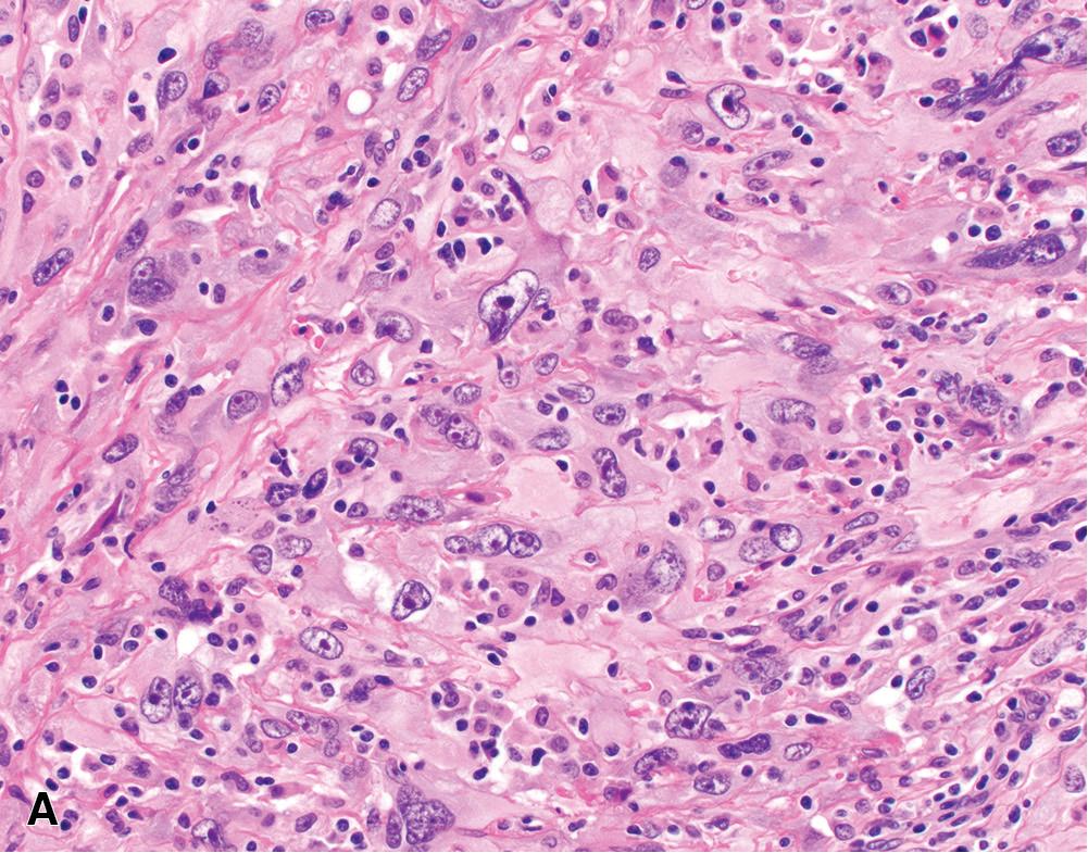 Figure 21.17, Pleomorphic mesothelioma, (A) comprising sheets of polygonal to epithelioid cells with abundant eosinophilic cytoplasm and large pleomorphic nuclei with clumped to cleared chromatin and prominent macronucleoli (400×). This case was classified as a pleomorphic epithelioid malignant mesothelioma; however, individual cases of pleomorphic mesothelioma may be classified as epithelioid or sarcomatoid, depending on predominant histomorphology. (B) In this example, a more cohesive epithelioid component is present at the upper left, whereas a sarcomatoid component comprising individual round to spindled pleomorphic cells separated by fibrotic stroma is evident at center. Atypical mitoses and necrosis (upper left) are present (H&E, 200×).