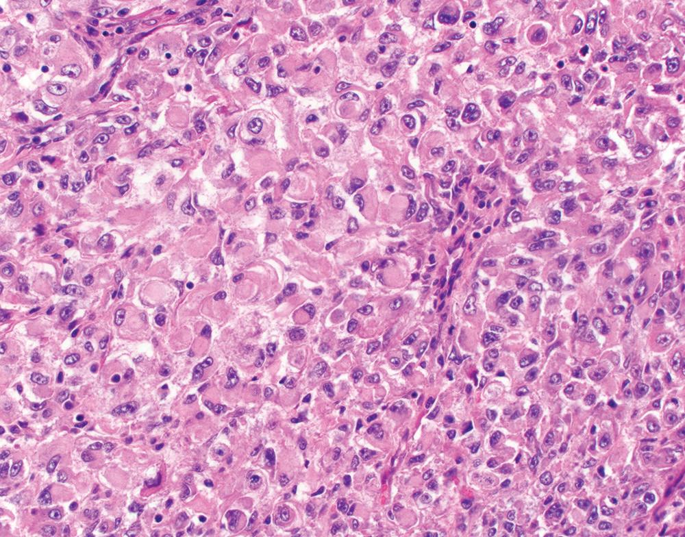 Figure 21.18, Epithelioid malignant mesothelioma with rhabdoid features, characterized by eccentric nuclei, displaced by a single prominent intracytoplasmic eosinophilic globule (H&E, 400×).