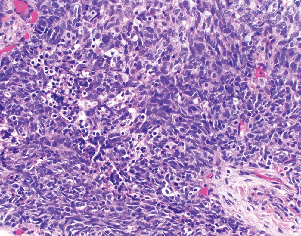 Figure 21.19, Epithelioid malignant mesothelioma with small cell features, characterized by small tumor cells with scant cytoplasm, imparting a blue appearance at low power. In contrast to true small cell lung cancer, mesothelioma with small cell features lacks neuroendocrine-type chromatin and has a much lower proliferation index (H&E, 400×).