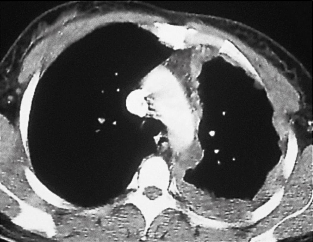 Figure 21.2, Computed tomography scan of the chest from a patient with pleural mesothelioma showing a multinodular and confluent tumor of the left chest.