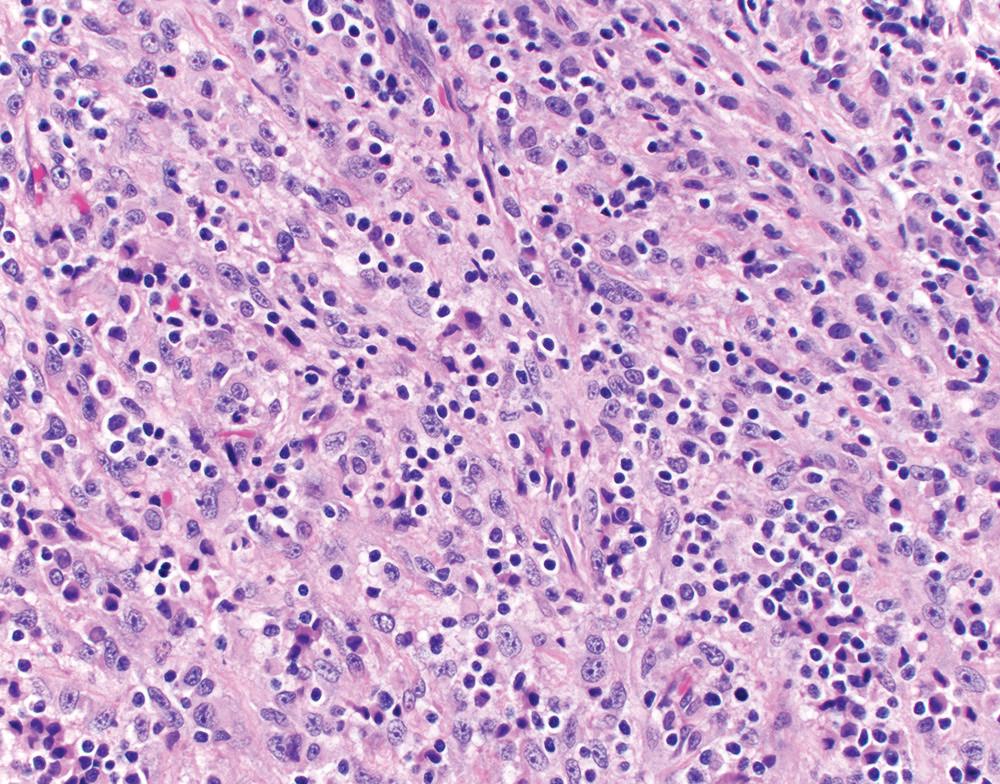 Figure 21.21, Mesothelioma with lymphohistiocytoid features. Scattered tumor cells are recognizable by their vesicular chromatin and prominent nucleoli; however, they resemble histiocytes, with foamy amphophilic cytoplasm and ill-defined borders, which are further obscured by a brisk lymphocytic infiltrate. This tumor was classified as a sarcomatoid mesothelioma, given the predominant spindled pattern of tumor cells (H&E, 400×).