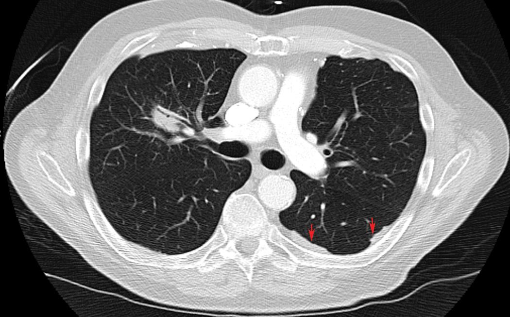 Figure 21.3, Computed tomography scan of the chest from a patient with right sided lung cancer and incidentally detected pleural plaques (red arrows) .