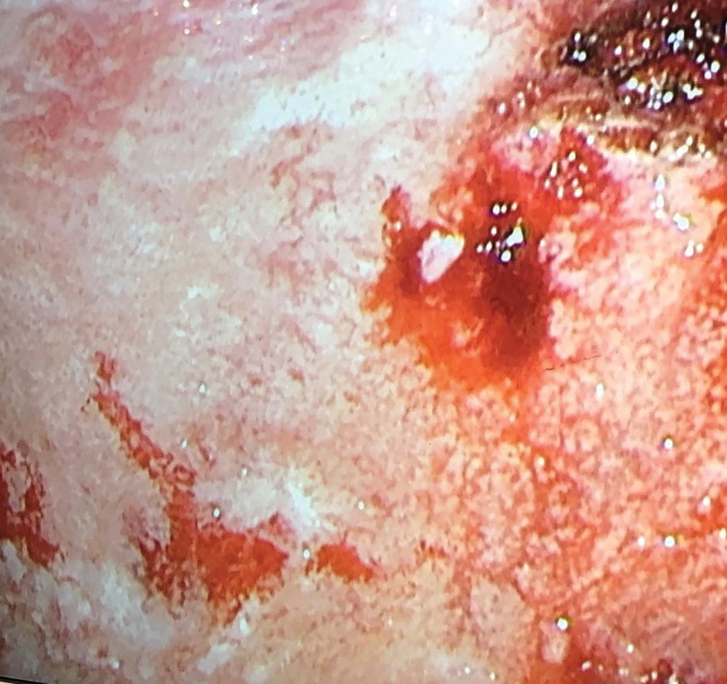 Figure 21.4, Thoracoscopic view of mesothelioma coating the surface of the visceral pleura as nodules and plaques.