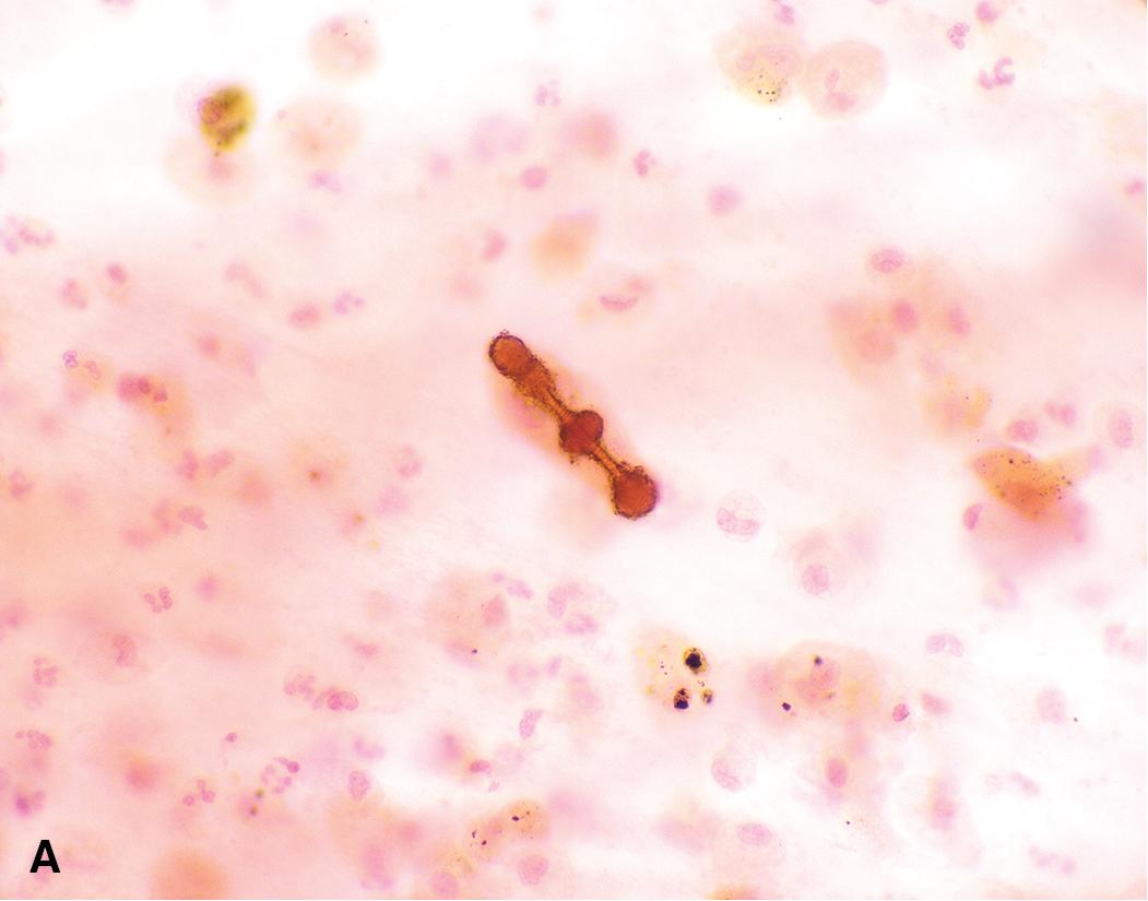 Figure 21.5, Ferruginous bodies (A) on H&E stain and (B) Papanicolaou stain (both 60× magnification).