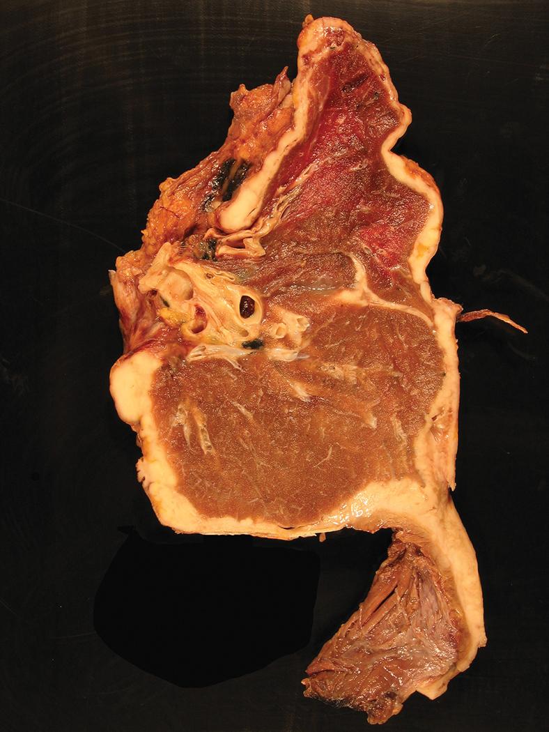 Figure 21.8, A gross photograph of a sagittal section of a lung specimen following extrapleural pneumonectomy performed for pleural mesothelioma. The tumor appears as a pale-colored rind coating the entire exterior surface of the lung with adherent parietal pleura and diaphragm.