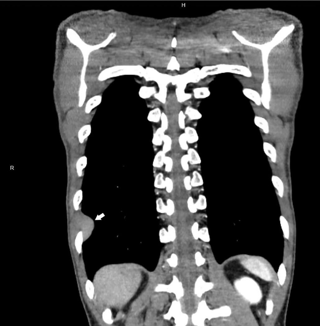 Figure 21.9, Computed tomography scan showing localized pleural mesothelioma involving the right chest, characterized by a solitary, well-circumscribed pleura-based mass with smooth contours (arrow) .