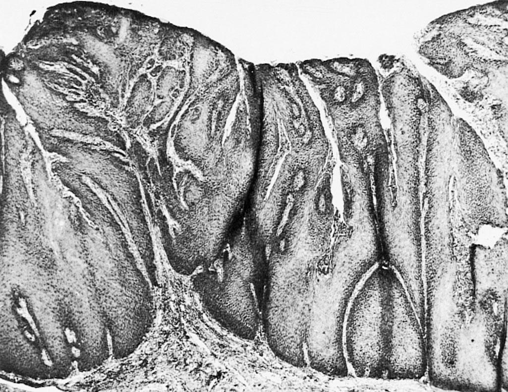 Fig. 31.2, Verrucous carcinoma. Downgrowths of papillae have broad bases. Tumor cells are well differentiated (original magnification ×34).