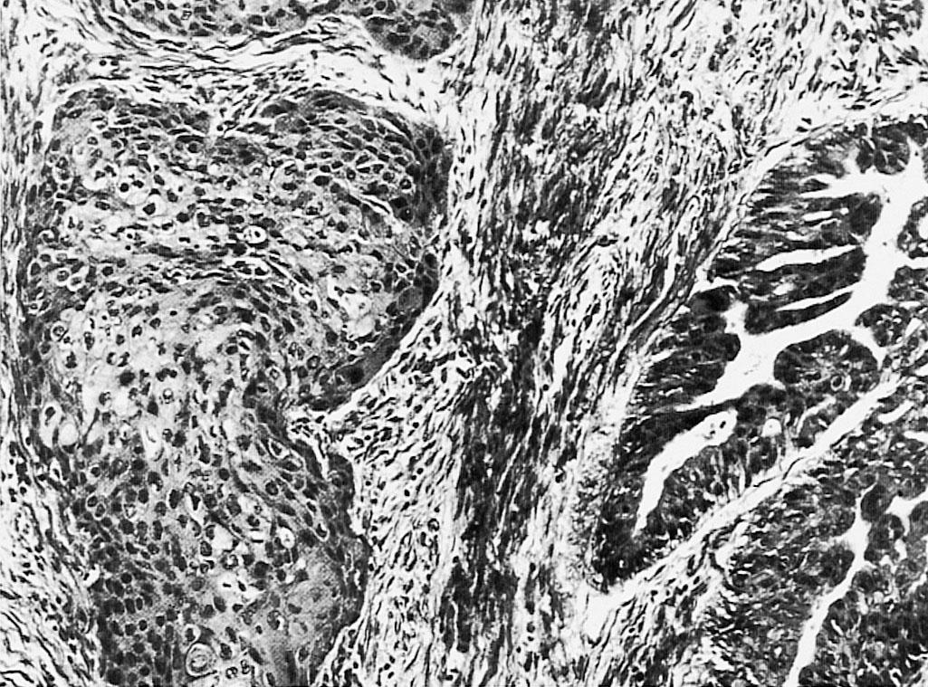 Fig. 31.5, Well-differentiated adenosquamous carcinoma. Glandular structure lies adjacent to a nest of nonkeratinizing large squamous cells (original magnification ×400).