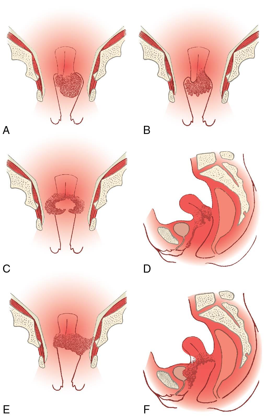 Fig. 31.7, Staging of cervical carcinoma. A, Stage IB, nodular cervix. B, Stage IIA, carcinoma extending into left vault. C, Stage IIB, parametrium involved on both sides, but carcinoma has not invaded pelvic wall; endocervical crater. D, Stage IIIA, submucosal involvement of anterior vaginal wall and small papillomatous nodule in its lower third. E, Stage IIIB, parametrium involved on both sides; at left, carcinoma has invaded pelvic wall. F, Stage IVA, involvement of bladder.