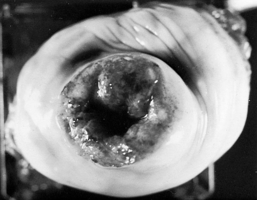 Fig. 31.8, Carcinoma of the cervix (gross specimen).