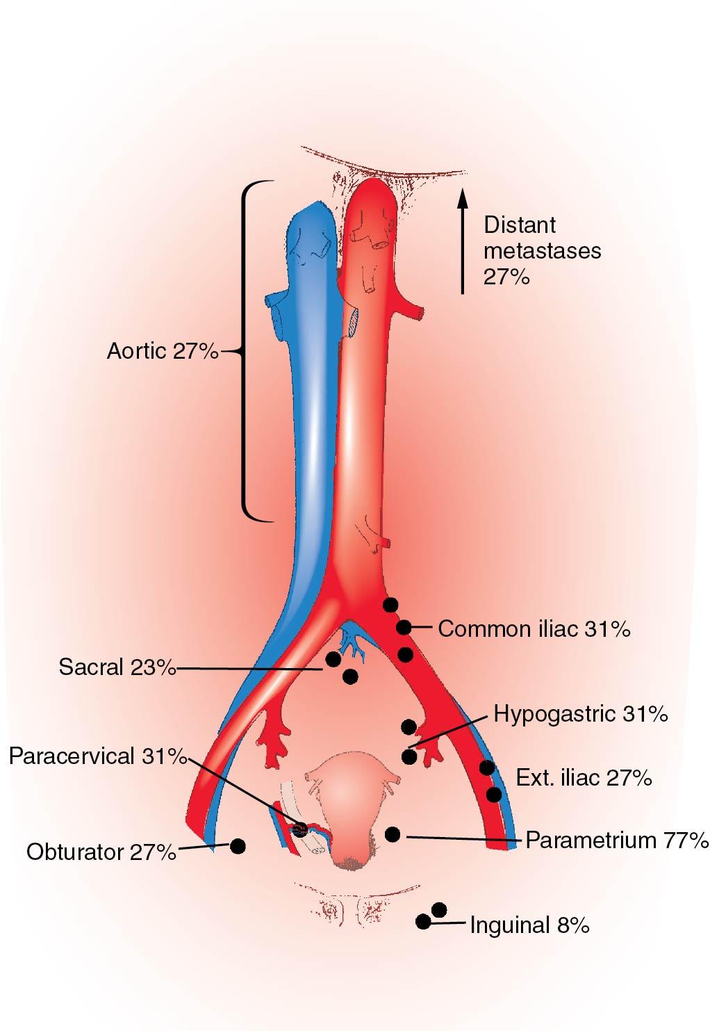 Fig. 31.9, Frequency of lymph node metastases in cervical carcinoma. Shown is the incidence of node group involvement in 26 nontreated cases of cervical carcinoma. Ext, External.