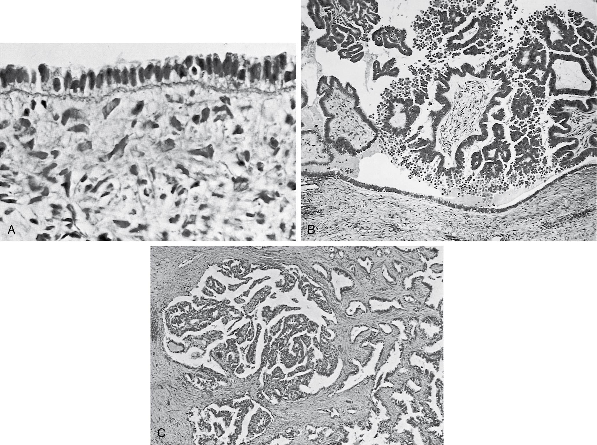 Fig. 33.2, A, Ciliated epithelium of a well-differentiated serous tumor (original magnification ×800). B, Serous papillary cystadenoma of borderline malignancy. The epithelium resembles that of the fallopian tube, and a well-developed papillary pattern is present (original magnification ×80). C, Serous papillary adenocarcinoma (original magnification ×50). The neoplastic epithelium invades the stroma.