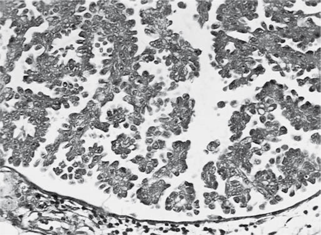 Fig. 33.12, Noninvasive implant, epithelial type. Branching papillae and detached clusters of polygonal cells showing moderate cytologic atypicality are present (hematoxylin-eosin stain, original magnification ×313). (From Bell DA, Weinstock MA, Scully RE. Peritoneal implants of ovarian serous borderline tumors: histologic features and prognosis. Cancer. 1988;62(10):2212-2222.)