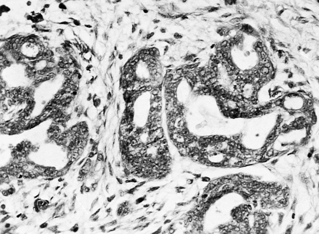 Fig. 33.13, Invasive implant. Glands with an irregular contour lined by severely atypical epithelial cells with extensive intraglandular bridging are present (hematoxylin-eosin stain, original magnification ×313).