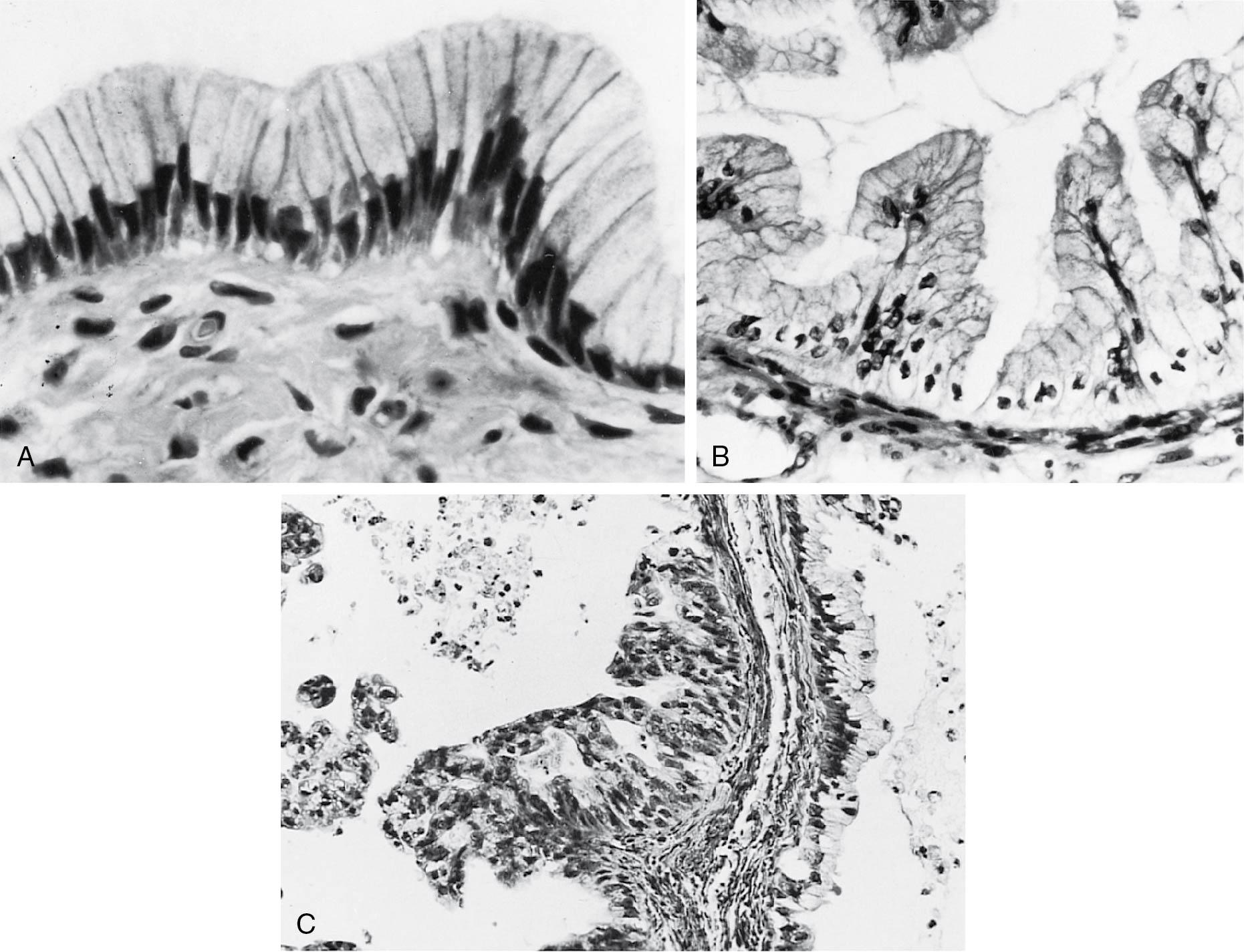 Fig. 33.3, A, Mucinous cystadenoma (original magnification ×800). B, Mucinous borderline tumor. Epithelium resembles that of the endocervix. C, Mucinous carcinoma (original magnification ×120). Incomplete stratification of cells, and atypicality is present.