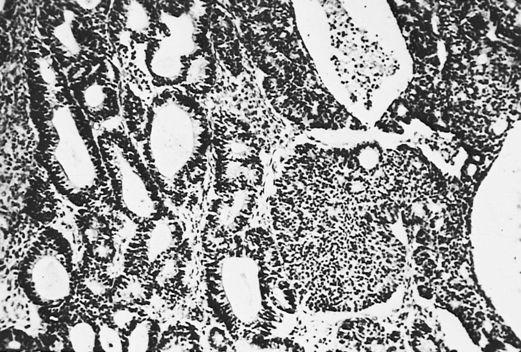 Fig. 33.4, Endometrioid carcinoma. Tubular glands are lined by stratified endometrium (original magnification ×80).