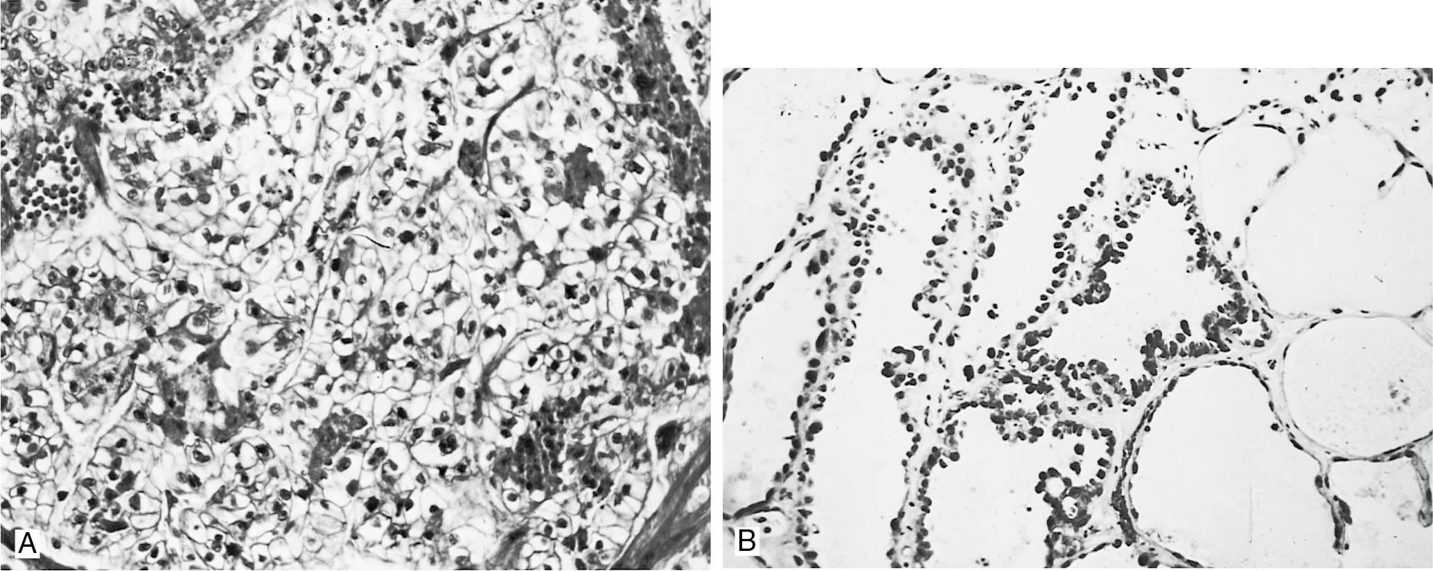 Fig. 33.5, A, Clear cell adenocarcinoma (original magnification ×200). A solid pattern of abundant polyhedral tumor cells containing abundant clear cytoplasm is present. B, Clear cell adenocarcinoma (original magnification ×200). Left: Hobnail cells with scant cytoplasm; protruding nuclei line shows tubules . Right: Cysts lined by flattened tumor cells.