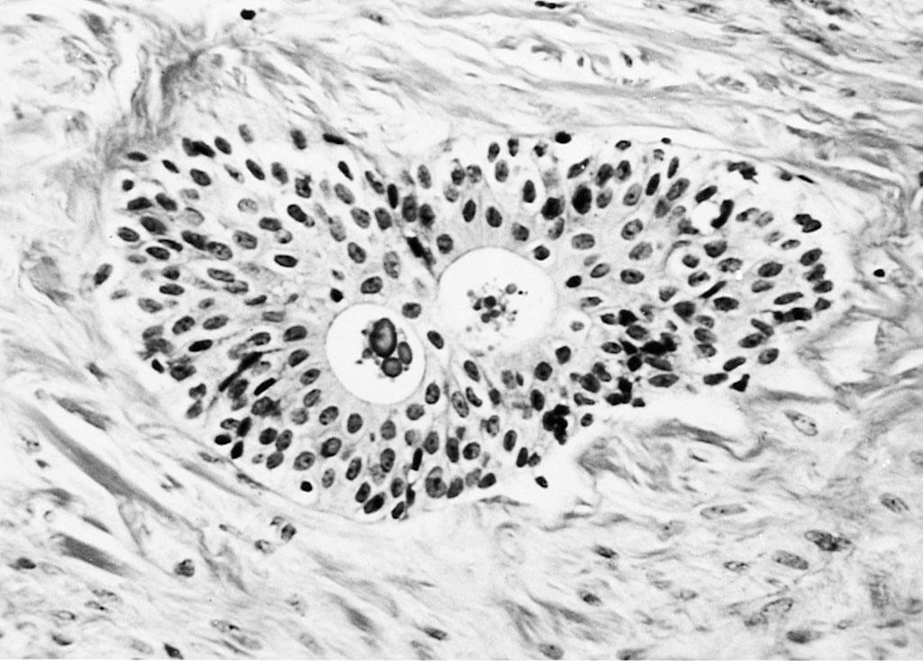 Fig. 33.6, Brenner tumor (original magnification ×350). Note the nest of transition-like epithelium containing spaces with eosinophilic material.