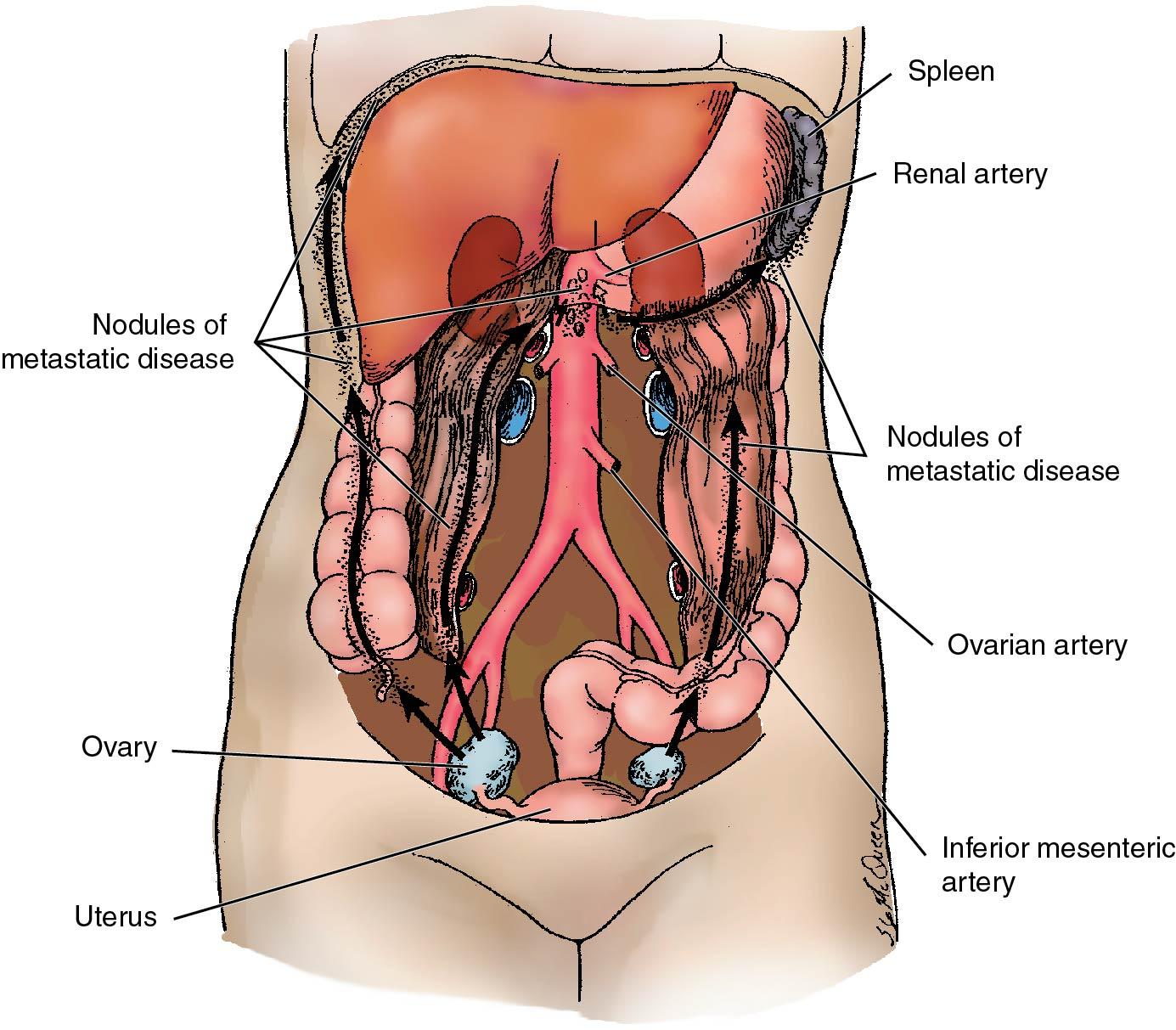 Fig. 33.7, Peritoneal spread of ovarian cancer. Portions of the omentum, small intestine, and transverse colon have been resected.