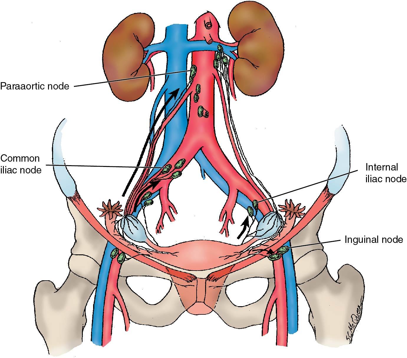 Fig. 33.8, Lymph nodes draining ovaries. Primary routes of spread to the pelvic and paraaortic nodes are illustrated.