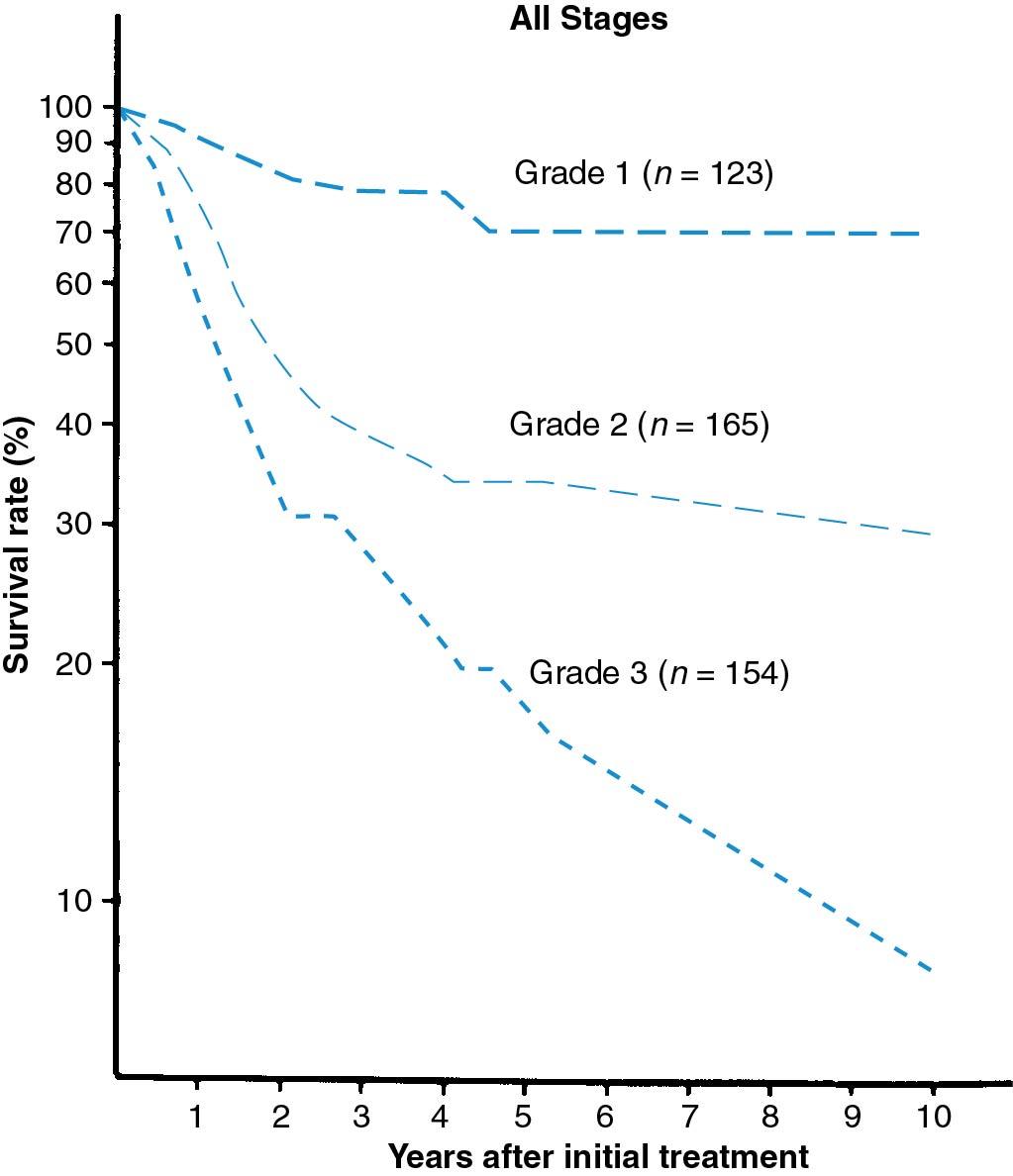 Fig. 33.10, Survival rates for patients with ovarian cancer by tumor grade. Survival curves for the complete series according to the histologic degree of differentiation. All differences between curves are highly significant.