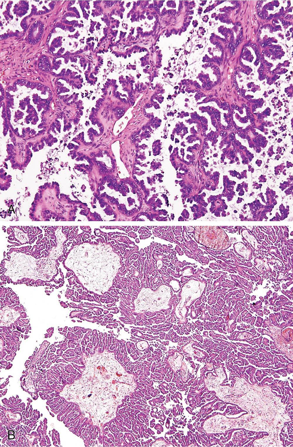 Fig. 33.11, Serous borderline ovarian tumor histologic examination. A, Atypical proliferating tumor. B, Micropapillary/cribriform (noninvasive low-grade serous carcinoma) pattern.