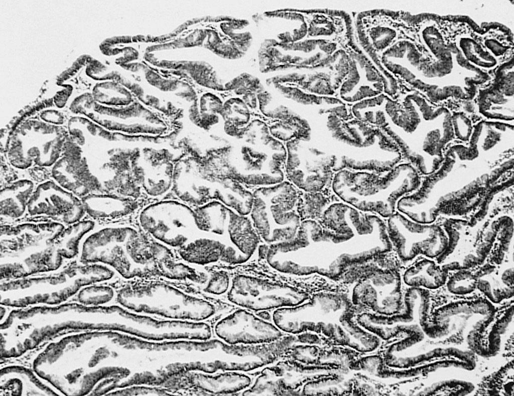 Fig. 32.3, Complex hyperplasia characterized by crowded back-to-back glands with complex outlines.