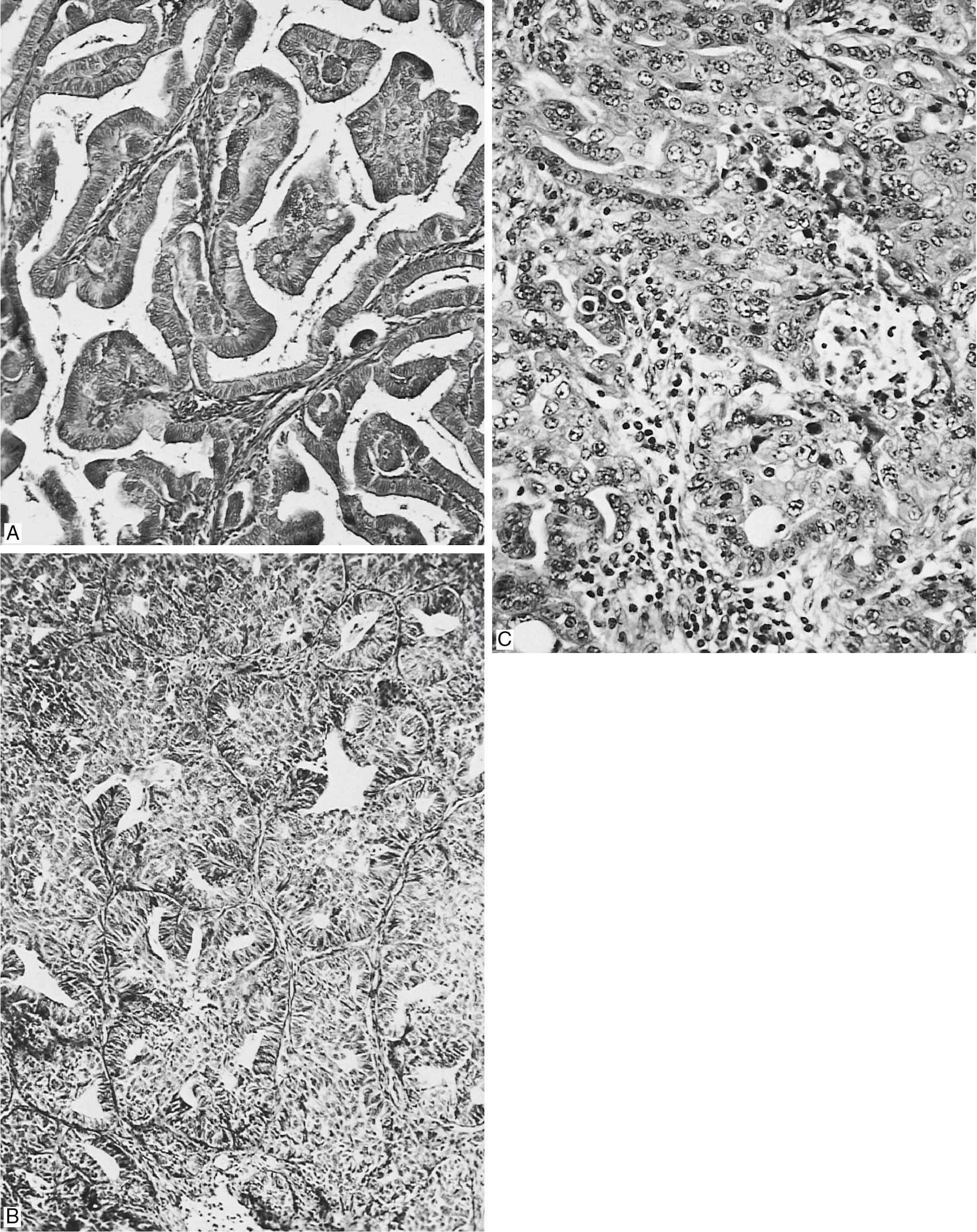 Fig. 32.5, A, Well-differentiated adenocarcinoma of the endometrium. The glands are confluent. (Original magnification ×130.) B, Moderately differentiated adenocarcinoma of the endometrium. The glands are more solid, but some lumens remain. (Original magnification ×100.) C, Poorly differentiated adenocarcinoma of the endometrium. The epithelium shows solid proliferation with only a rare lumen. (Original magnification ×100.)