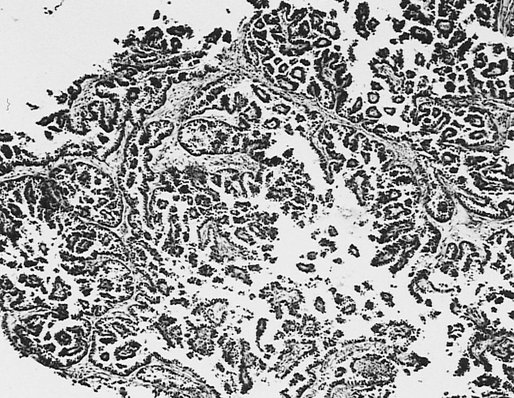 Fig. 32.6, Serous carcinoma characterized by a complex papillary architecture resembling serous carcinoma of the ovary.