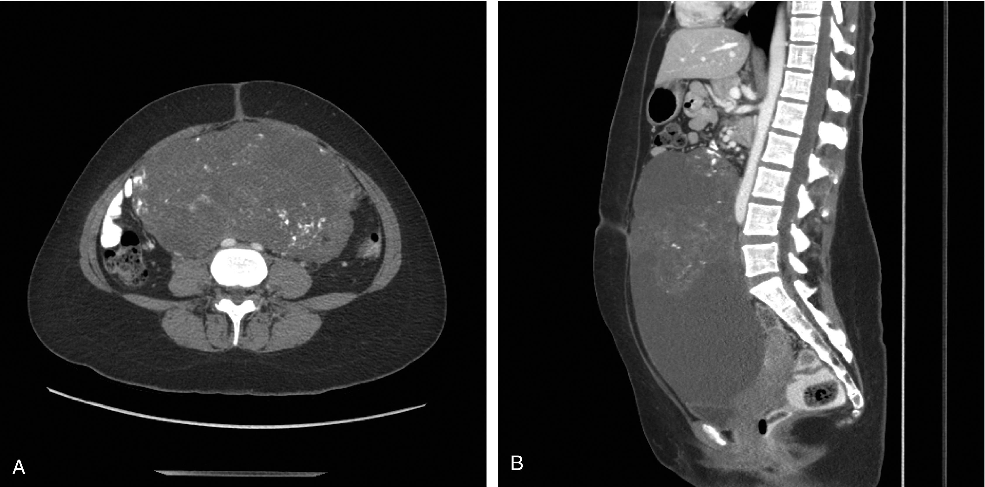 Fig. 1.1, Axial (A) and sagittal (B) views of a mixed germ cell tumor presenting as a 24 cm abdominal-pelvic mass with elevated AFP and beta-hCG.