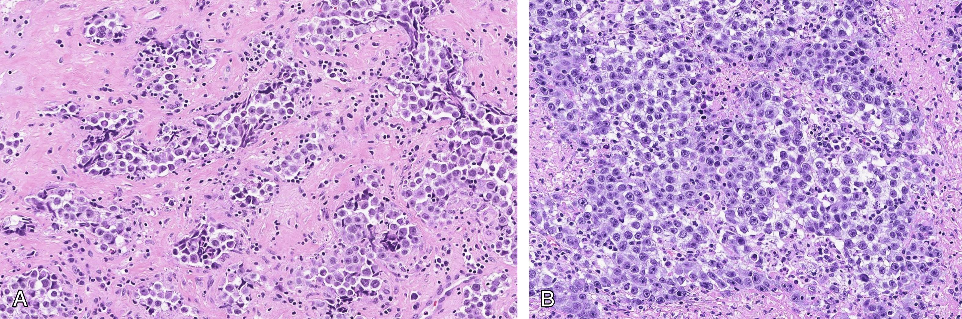 Fig. 1.2, Dsygerminomas showing nests and cords of tumor cells with intervening fibrous septae (A). Tumor cells have abundant cytoplasm and prominent nucleoli. Scattered lymphocytes are present around the tumor nests (B).