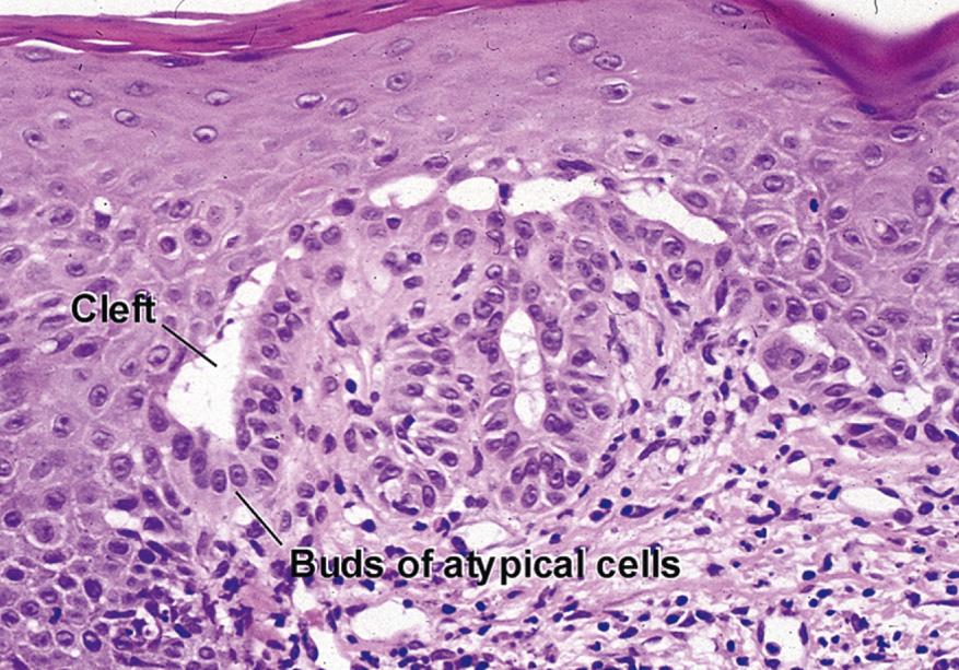 Fig. 3.2, Acantholytic actinic keratosis