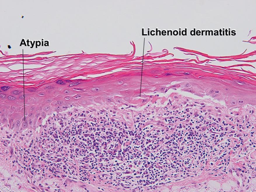 Fig. 3.3, Lichenoid actinic keratosis