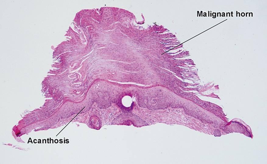 Fig. 3.4, Hypertrophic actinic keratosis