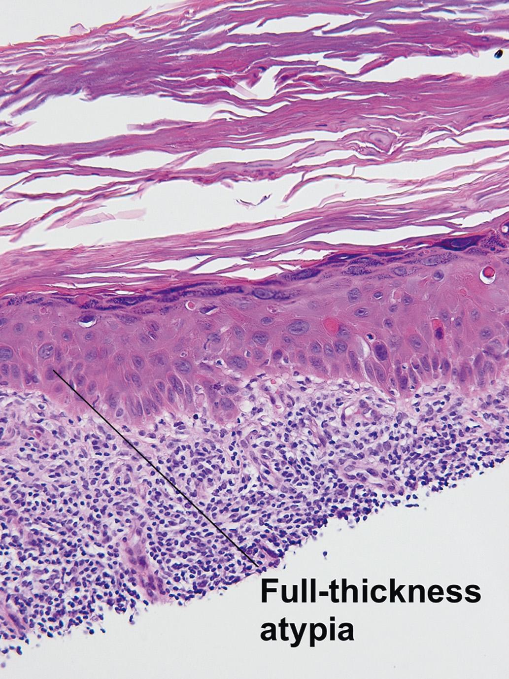 Fig. 3.5, Bowenoid actinic keratosis