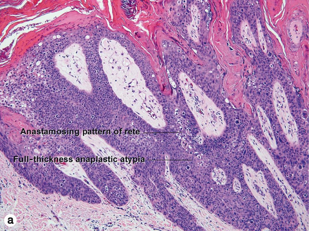 Fig. 3.6, Bowen disease