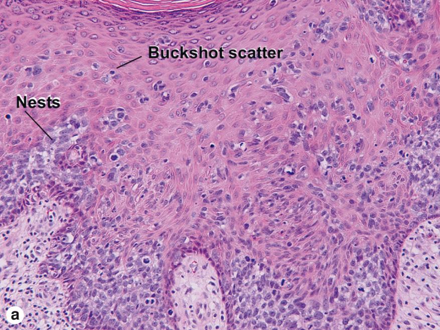 Fig. 3.7, Bowen disease: buckshot scatter of atypical cells