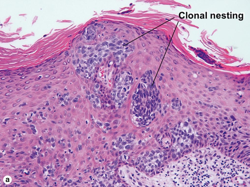 Fig. 3.8, Bowen disease: clonal nesting of atypical cells