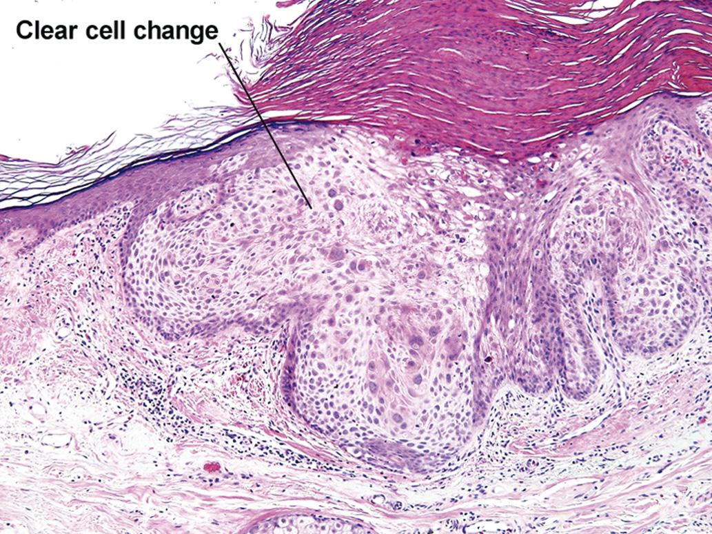 Fig. 3.9, Clear cell change in Bowen disease