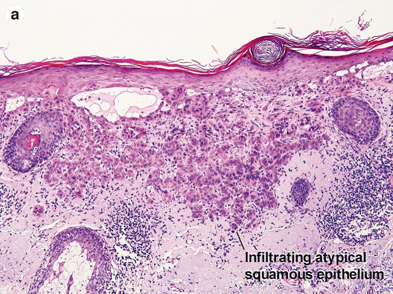 Fig. 3.10, (A and B) Well-differentiated invasive squamous cell carcinoma (C) Acantholytic squamous cell carcinoma. (D and E) Desmoplastic squamous cell carcinoma (H&E and keratin 903 immunostain)