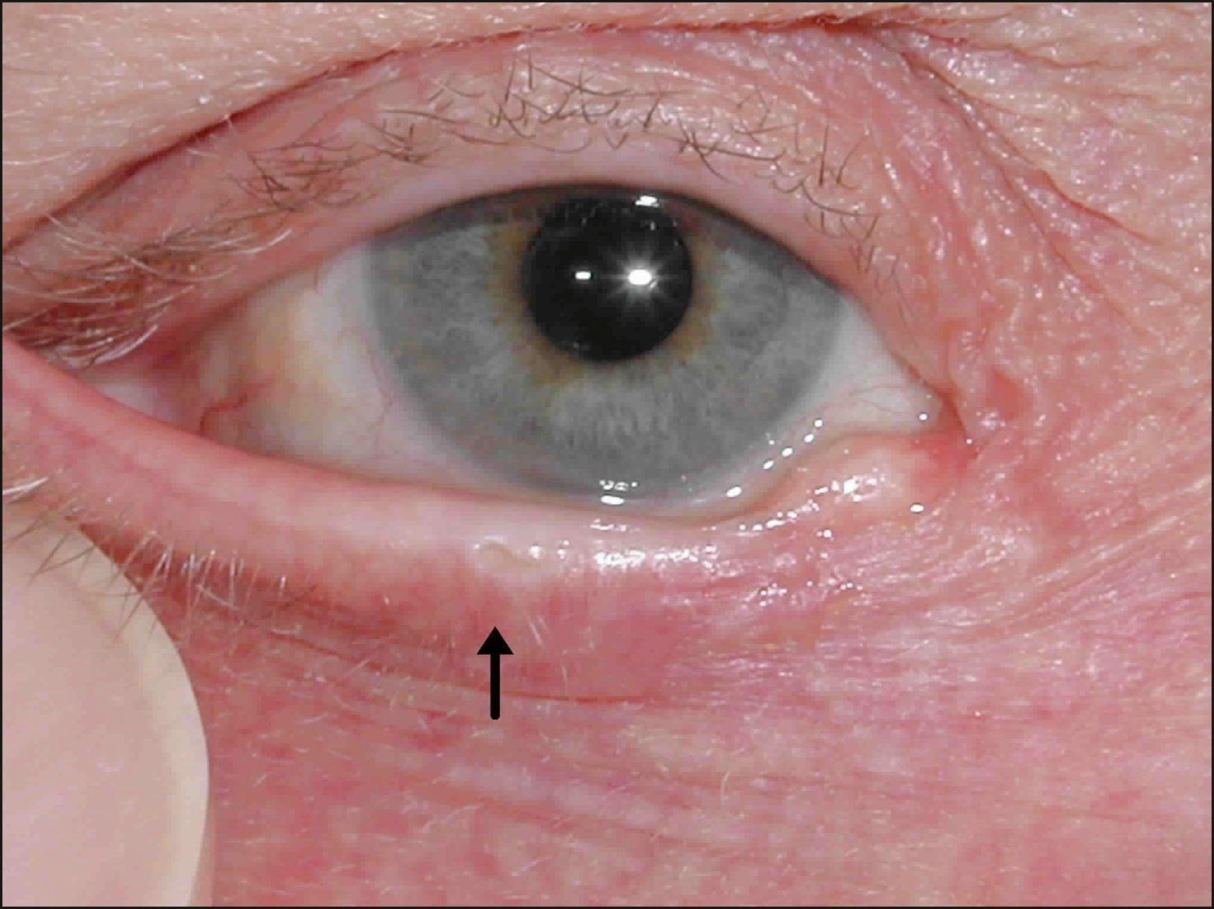 Fig. 26.1, Testing medial canthal tendon tone by distracting the eyelid laterally and measuring the horizontal movement of the punctum.