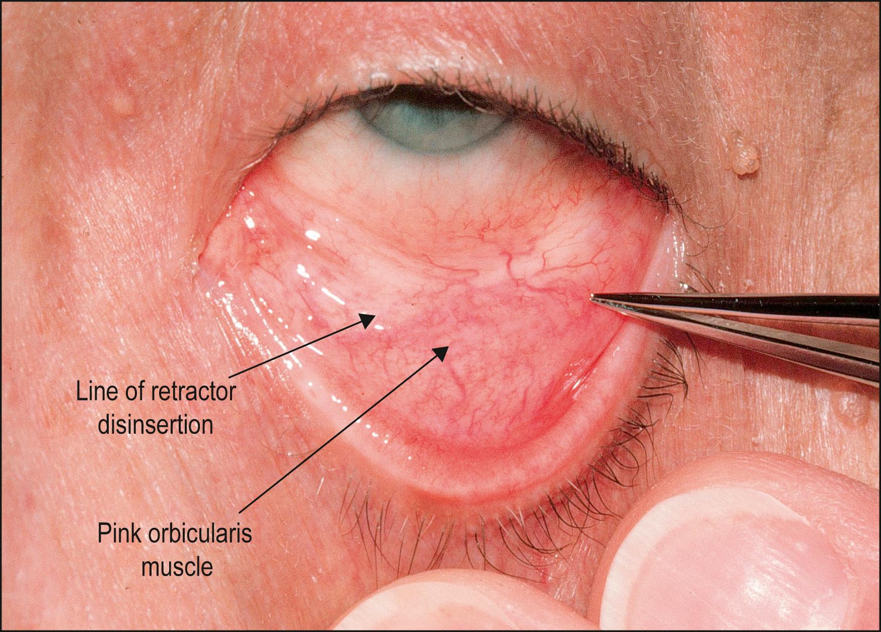 Fig. 26.3, The disinserted inferior retractors are visualized as a white band in the fornix on examination. The pink tissue superior to the leading edge of the retractors is the orbicularis muscle seen through conjunctiva.