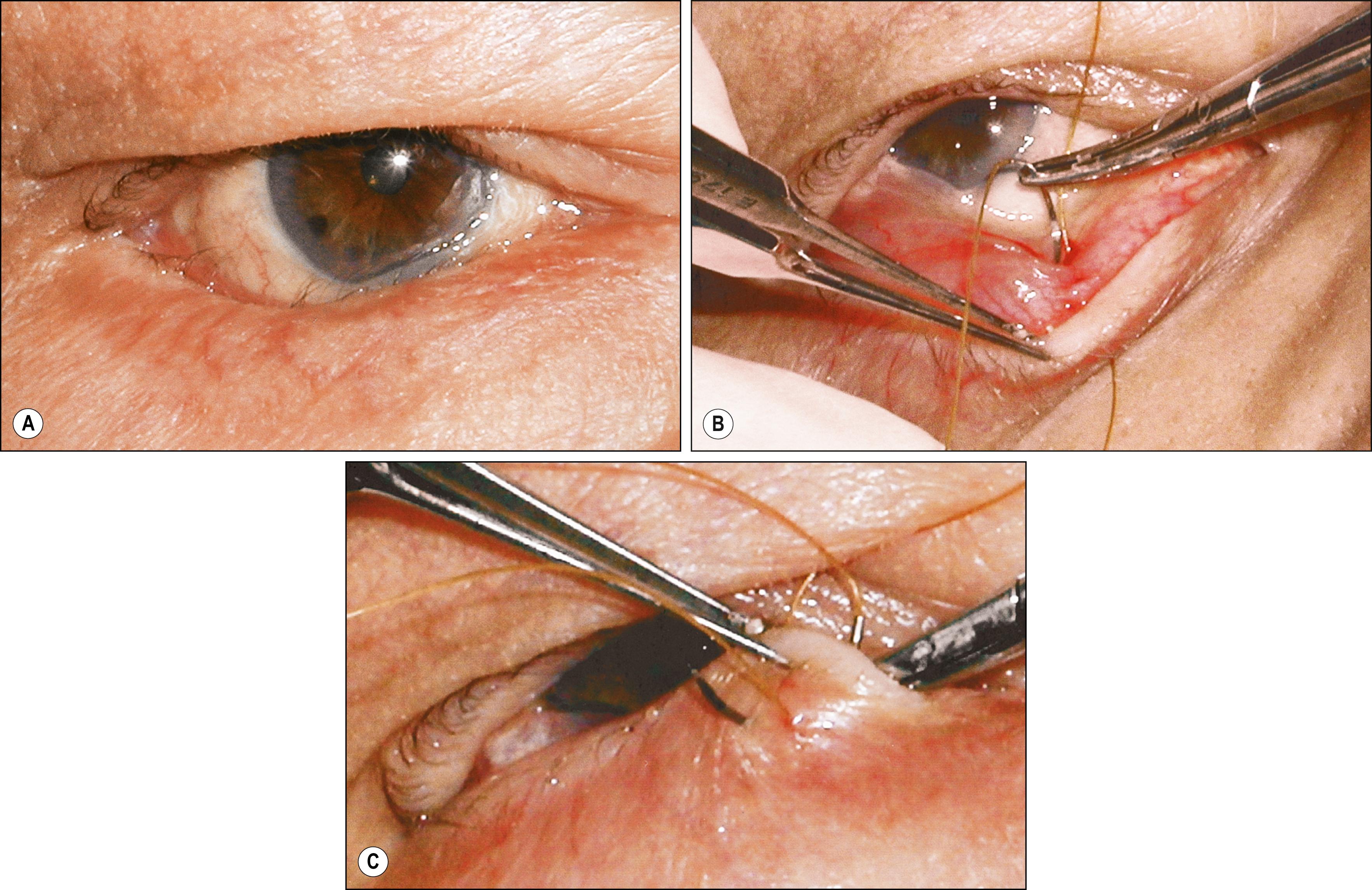 Fig. 26.6, ( A ) Preoperative entropion before placement of Quickert sutures. ( B ) Needle passed deep into fornix to pick up retractors. ( C ) Needle exiting through skin at a level higher than the entry.