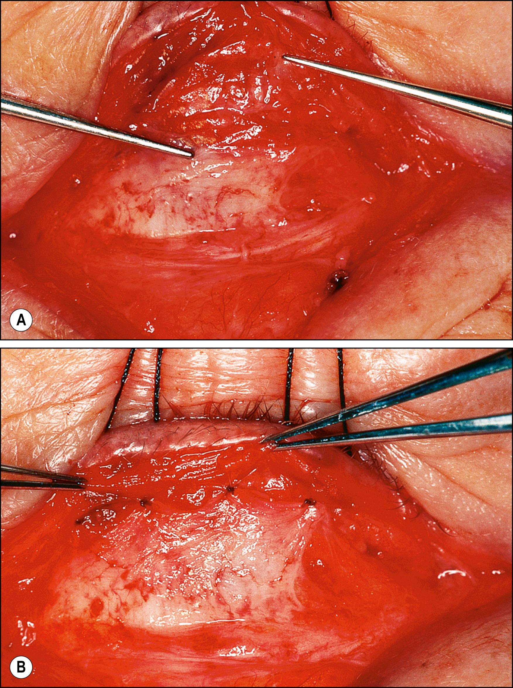 Fig. 26.7, ( A ) Anterior subciliary approach, with the retractors disinserted (left pointer) from the inferior tarsal border (right pointer) . ( B ) Edge of the retractors sutured to the inferior tarsal border with permanent sutures.