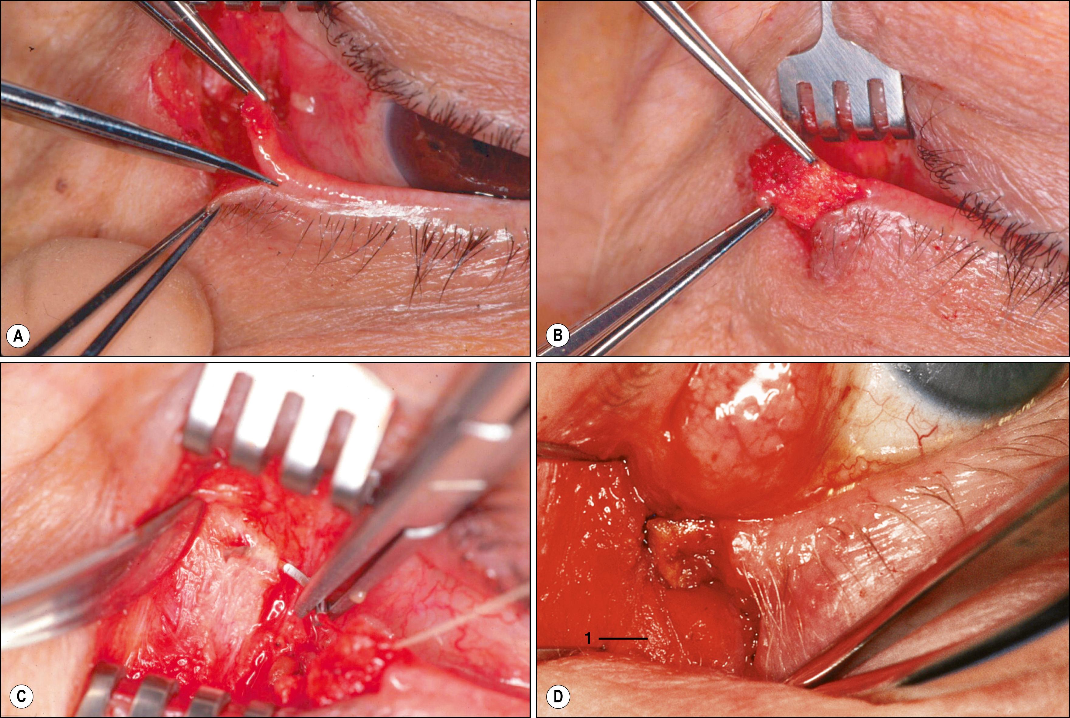 Fig. 26.8, Lateral tarsal strip procedure. ( A ) Splitting the anterior and posterior lamella. ( B ) The tarsal strip denuded of hair follicles, skin, and margin epithelium. ( C ) Passing suture through periosteum at Whitnall tubercle. ( D ) Completed lateral tarsal strip procedure.