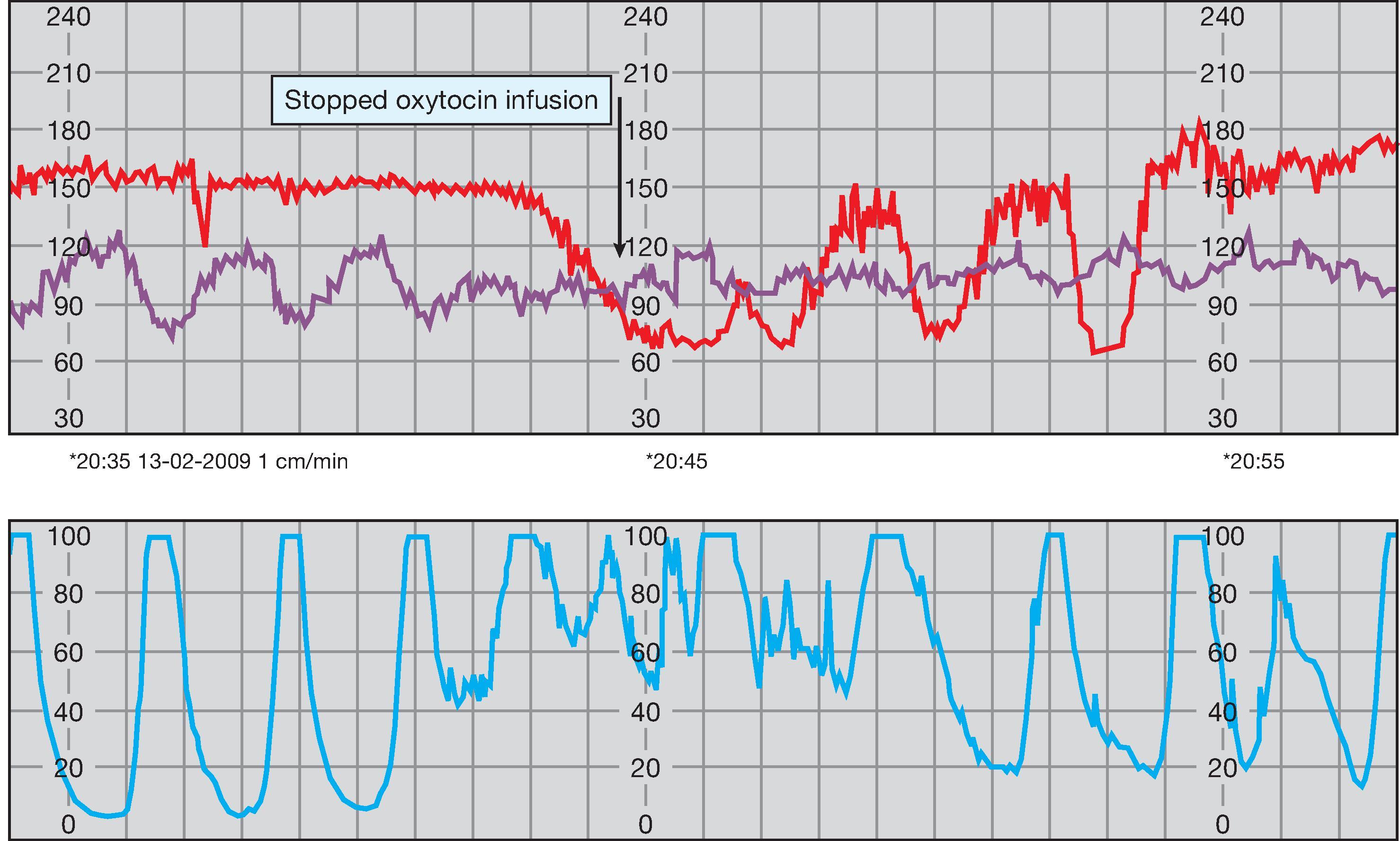 Fig. 34.1, Cardiotocograph trace in precipitate labour. There is hyperstimulation secondary to oxytocin administration. When the oxyocin infusion is stopped, the contractions become less frequent and the cardiotocograph improves.