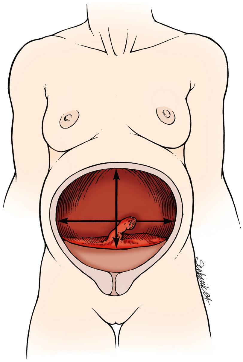 Fig. 17.2, Low Implantation of the Placenta.