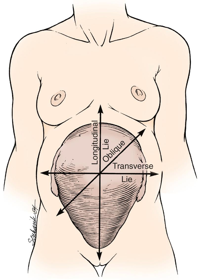 Fig. 17.3, A Fetus May Lie on a Longitudinal, Oblique, or Transverse Axis.